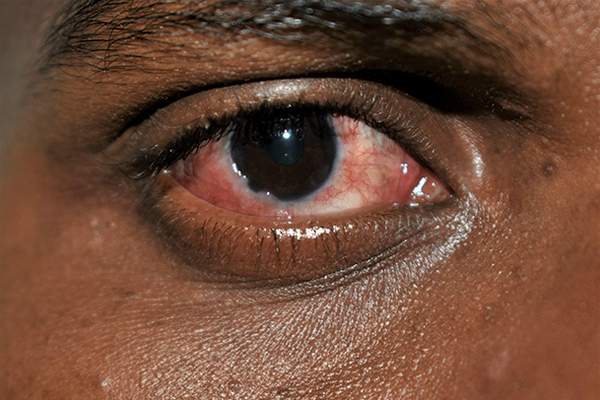 झारखंड में बढ़ रहे हैं Conjunctivitis के मरीज, ऐसे करें बचाव